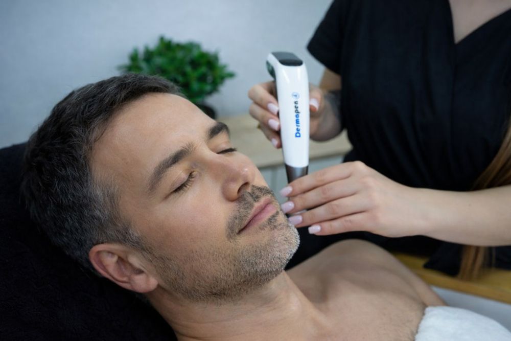 Dermapen czy radiofrekwencja mikroigłowa Vivace - którą metodę wybrać? dermapen