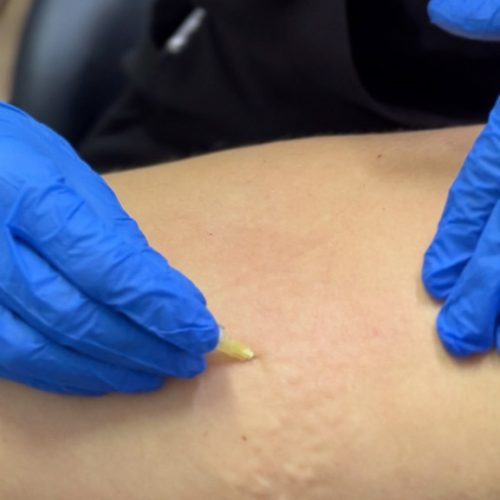 Pracownia Figury 6.Karboksyterapia Pracownia Figury Karboksyterapia