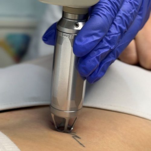 Pracownia Figury Usuwanie Tatuażu Pracownia Figury Usuwanie Tatuażu